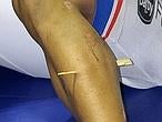 Gana el bronce tras clavarse una astilla de madera en la pierna
