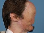 El «hombre sin rostro» supera con éxito el primer trasplante completo de cara