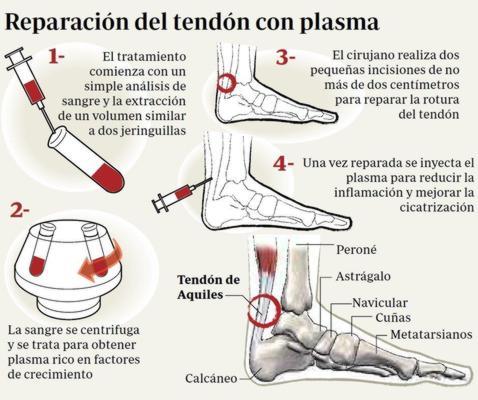 Una cirugía poco agresiva y plasma para cicatrizar el tendón de Aquiles del Rey