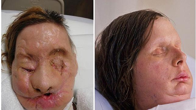 La mujer atacada por un chimpancé, elogiada tras su última operación de cara