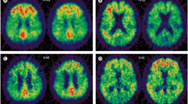 Las lesiones cerebrales pueden provocar alzhéimer