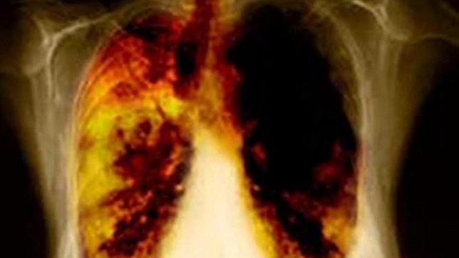 Descubren una terapia para prevenir el crecimiento del cáncer de pulmón