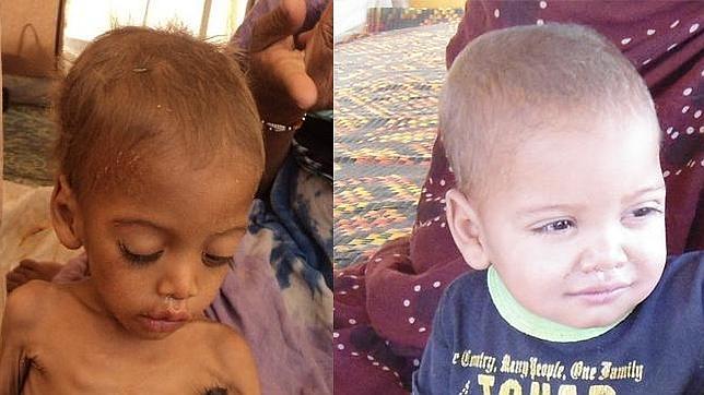 La desnutrición está detrás de una de cada tres muertes infantiles