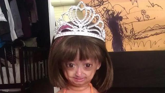 Adalia Rose, la niña con progeria y 5,8 millones de amigos