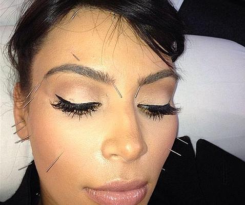 Kim Kardashian recurre a la acupuntura como método de belleza