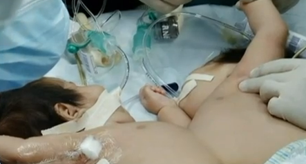 Dos siamesas son separadas con éxito en Perú tras ocho horas de operación