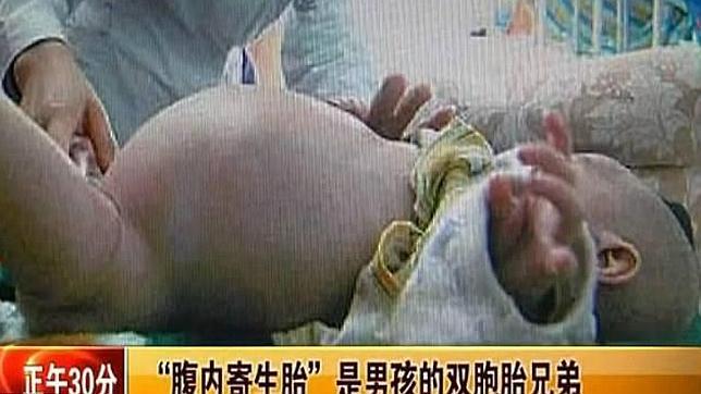 Descubren un feto en el estómago de un bebé de dos años