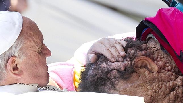La dolorosa historia del enfermo de neurofibromatosis al que abrazó el Papa