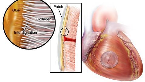 El pegamento lograr reparar la lesión en el vaso del corazón