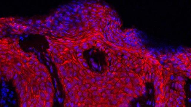 Investigadores del CNIO proponen dos nuevas vías para tratar la psoriasis