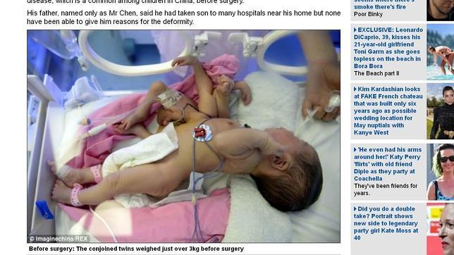 Operan con éxito el bebé chino que nació con cuatro manos y cuatro pies