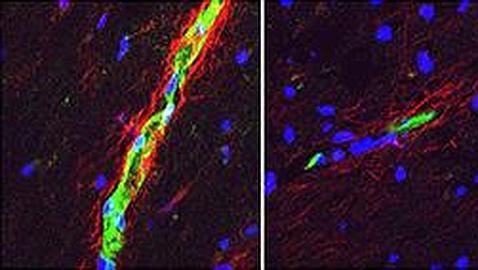 El sexo de la esclerosis múltiple