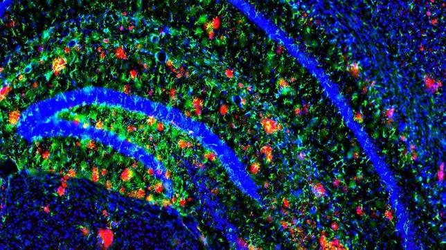 Un antidepresivo detiene la formación de placas beta amiloide en alzhéimer