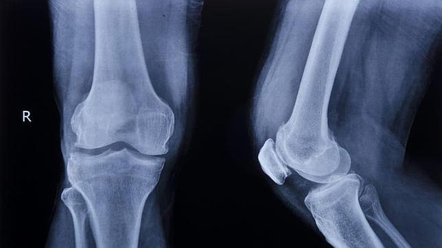 Implantan en pacientes huesos impresos en 3D