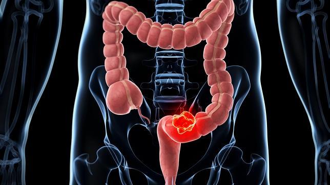 Palpitaciones, intestino irritable, dolor o somatizaciones, son las secuelas "físicas" del estrés