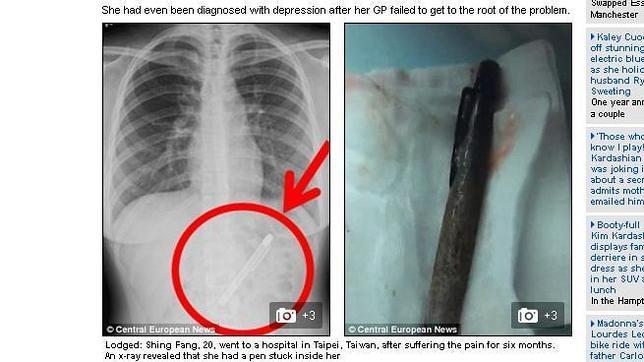 Le diagnostican depresión cuando tenía una pluma estilográfica en el estómago