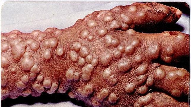 Un barco español llevó en 1803 la vacuna de la viruela a los confines del mundo