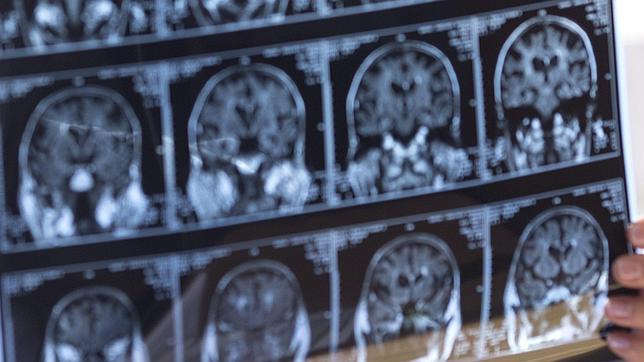 La vitamina D junto con el tratamiento se asocia a menos lesiones activas