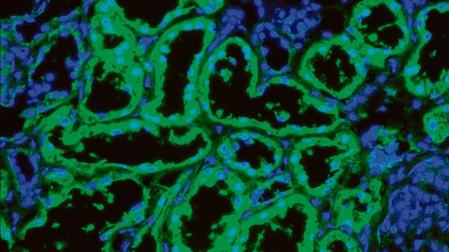 Identifican una enzima que detiene la progresión del cáncer de riñón más común