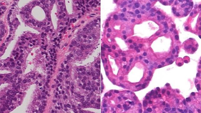 Fabrican organoides a partir de biopsias de cáncer de próstata
