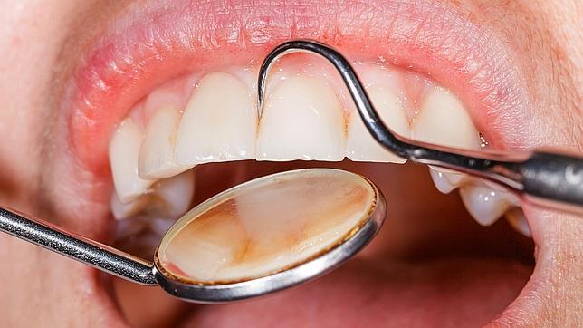 Una persona con periodontitis tiene más riesgo de sufrir un ictus