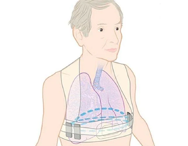Ilustración de la forma en la que este dispositivo evita problemas pulmonares