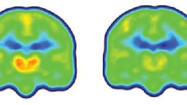 A la izda un cerebro de una persona con dolor crónico donde se ve la activación de la proteína (naranja y rojo), y a la dcha el de una personas sana, sin activación de la proteína