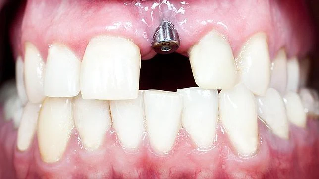 Implantes dentales: todo lo que debemos saber