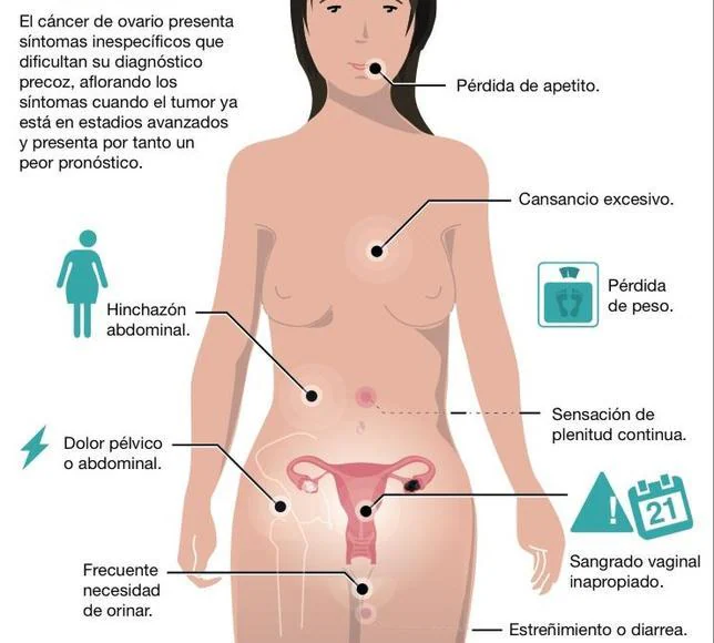 Síntomas del cáncer de ovario