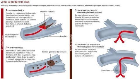 Los supervivientes de un ictus tienen más riesgo de desarrollar cáncer