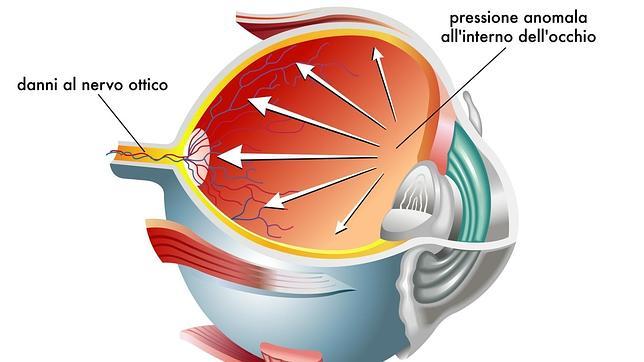 Hay dos tipos de glaucoma, dependiendo de que el aumento de la presión ocular sea crónico o puntual