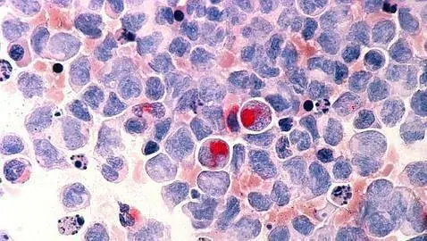 Células de cáncer de páncreas vuelven a su estado original no tumoral