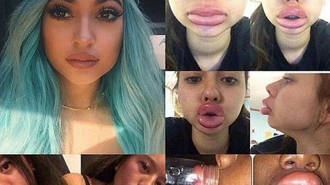 El peligroso desafío de las adolescentes: deformarse los labios para tenerlos gruesos como Kylie Jenner