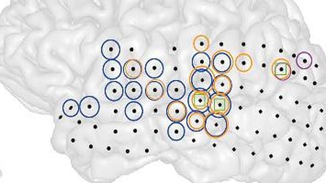 Graban por vez primera el efecto de los acúfenos en un cerebro vivo