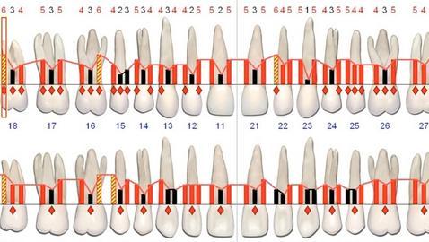 ¿Qué es la cirugía periodontal?