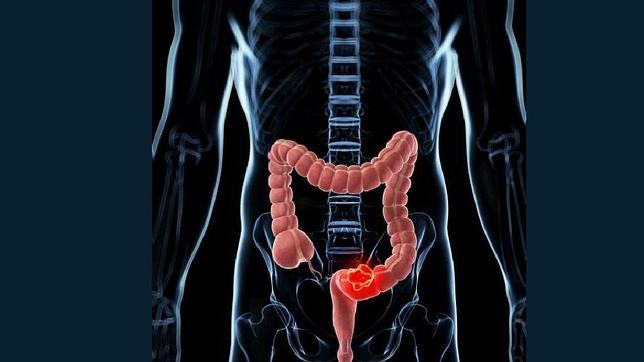 Un análisis mejora el porcentaje de acierto del TAC en el cáncer de colon