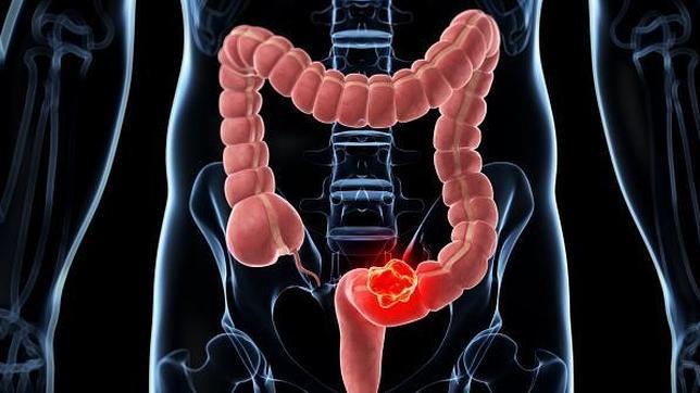 Un nuevo fármaco mejora la supervivencia en pacientes con cáncer de colon