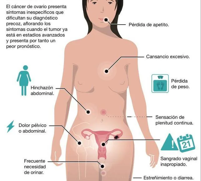 Síntomas de alerta del cáncer de ovario