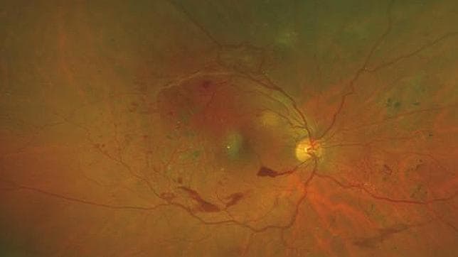 Este es el ojo de una persona con retinopatía diabética