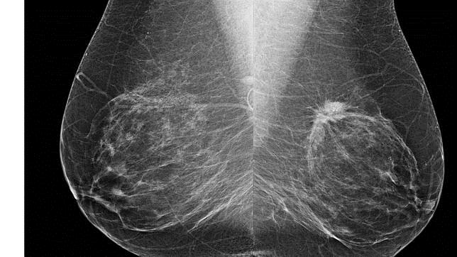 La mamografía digital detecta la presencia del cáncer