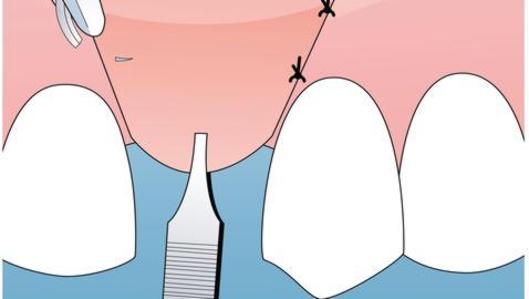 ¿Qué es la cirugía estética periodontal?