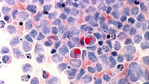 Células tumorales en un tipo de leucemia