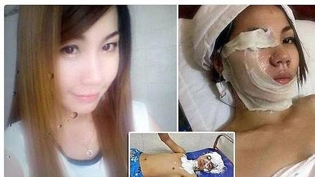 Una chica de Camboya intenta vengarse de su novio con ácido y termina herida