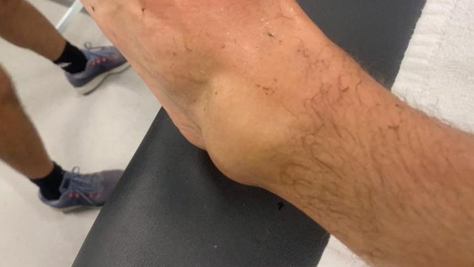 El llamativo estado del tobillo de Canales