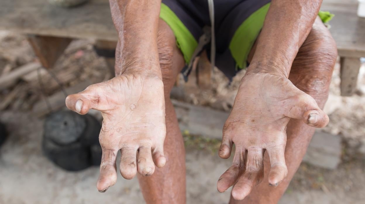 Imagen de un leproso con las manos afectadas