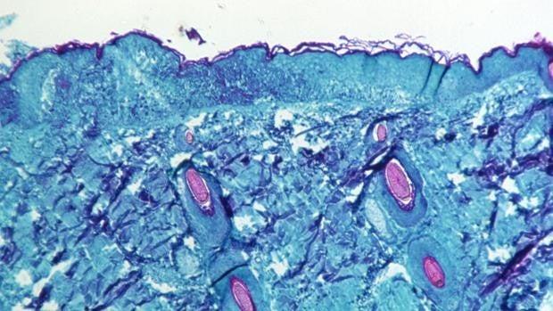 Andalucía tiene ya diez casos sospechosos de viruela del mono, todos hombres menores de 45 años