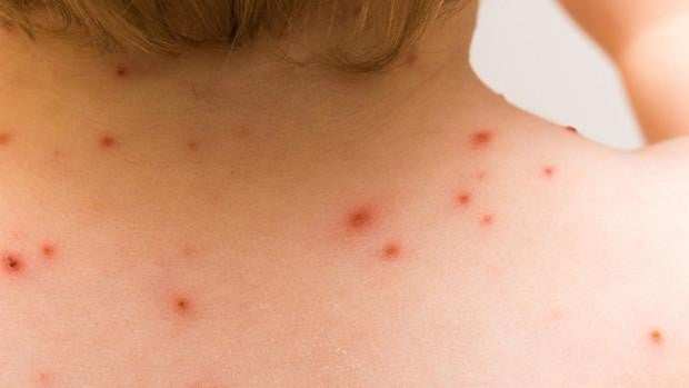 Andalucía tiene «casos y transmisión» de la viruela del mono y Salud teme que aumenten en verano