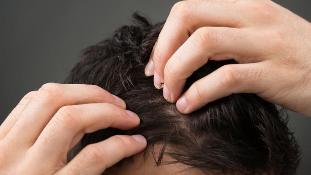 La calvicie, un problema capilar resuelto