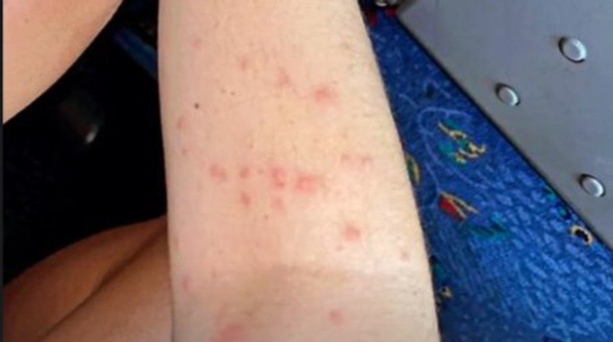 Una imagen de un brazo lleno de picaduras