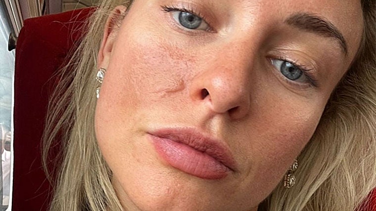 Um mês após o ataque e quatro sessões de laser